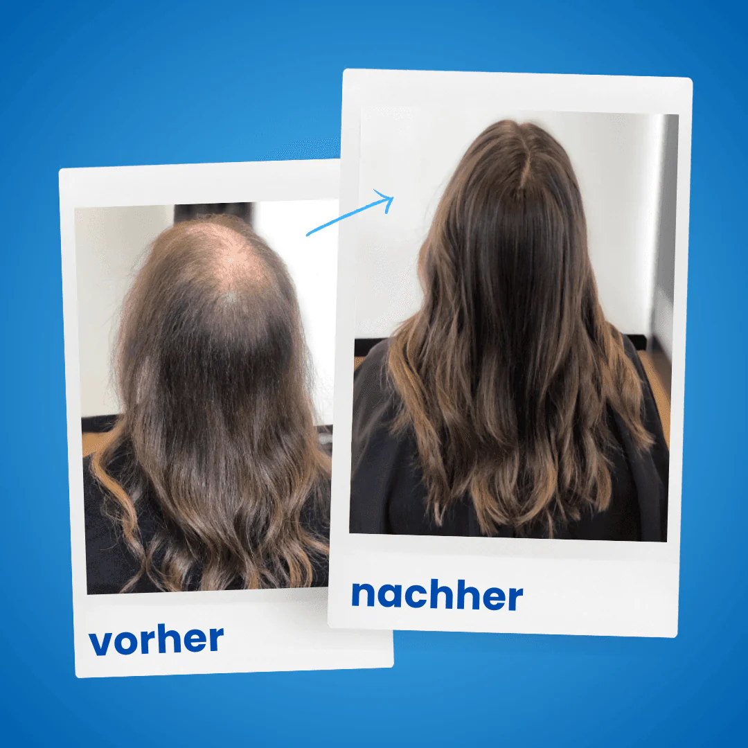 ShinyHair Haarwuchsbooster Sale - Image 7