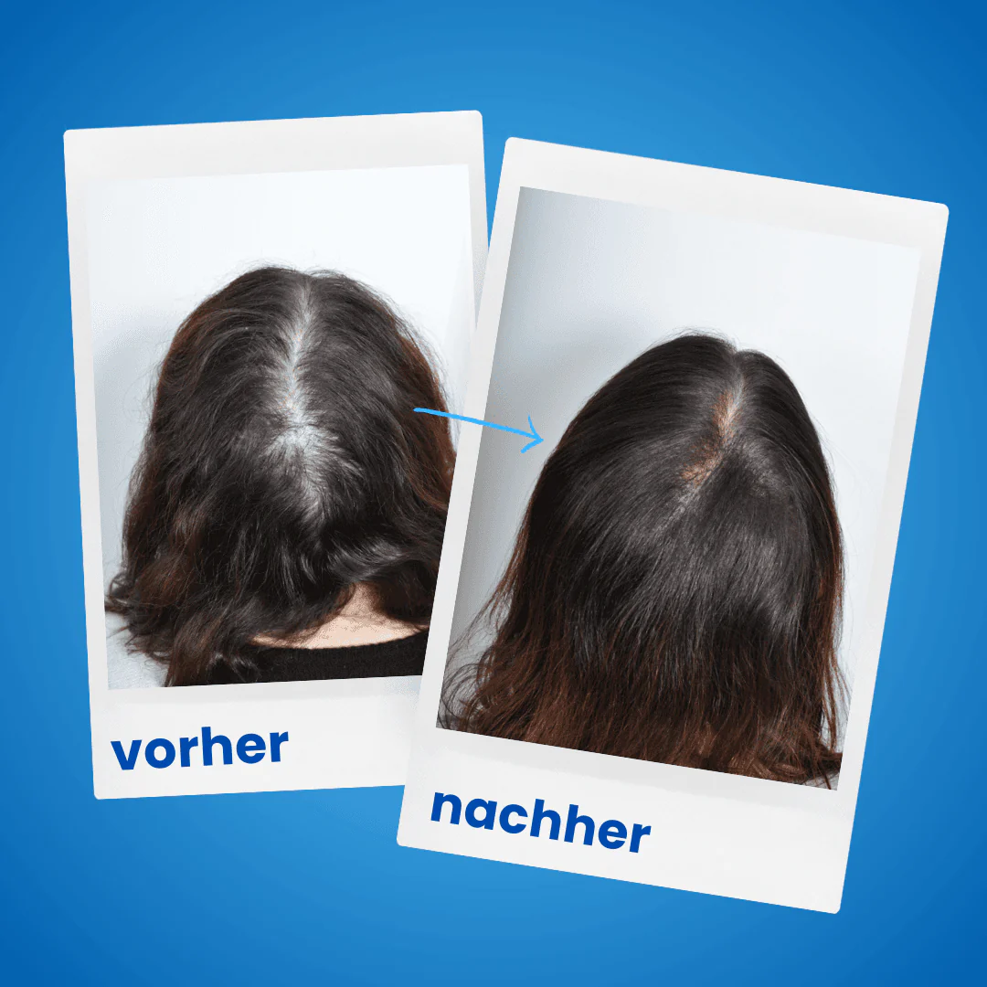ShinyHair Haarwuchsbooster Sale - Image 9